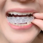 Facts You Didn't Know About Invisalign