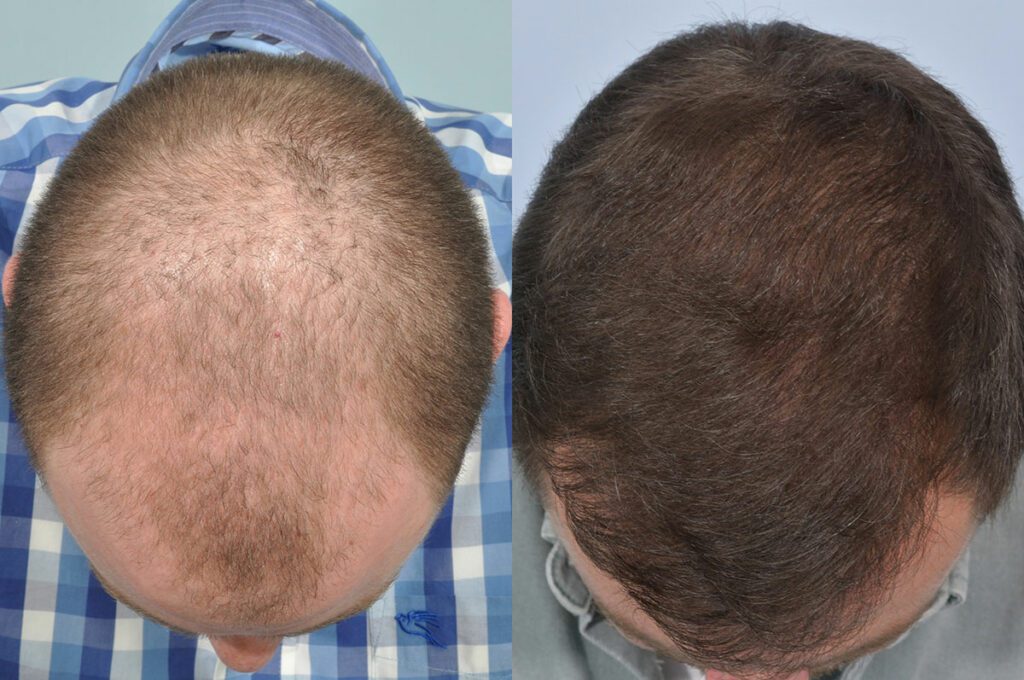 How Should You Prepare for Hair Transplant Surgery